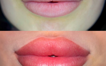 Lip Micropigmentation
