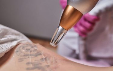Laser tattoo removal