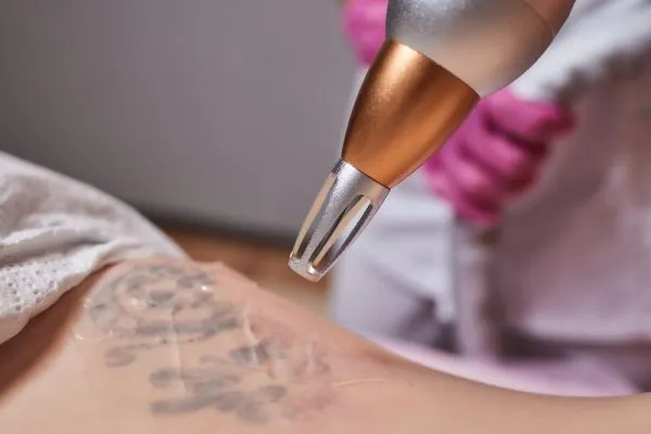 Laser tattoo removal